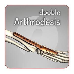 Double Arthrodesis locking plate